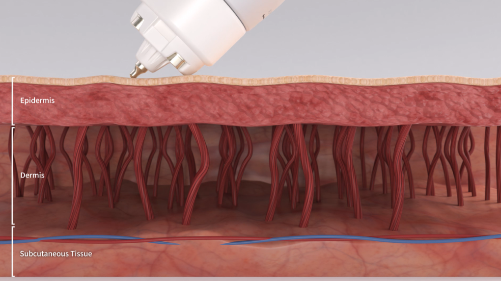 キュアジェット｜美容皮膚科｜たけのやま皮ふ科